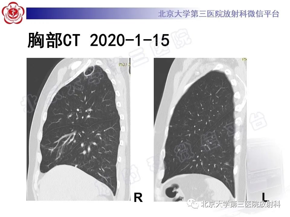 影像PPT - 【PPT】肺奴卡菌病-15
