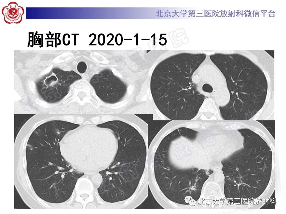 影像PPT - 【PPT】肺奴卡菌病-13