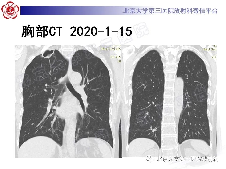 影像PPT - 【PPT】肺奴卡菌病-14
