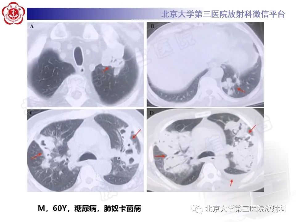 影像PPT - 【PPT】肺奴卡菌病-24