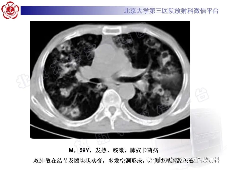 影像PPT - 【PPT】肺奴卡菌病-25