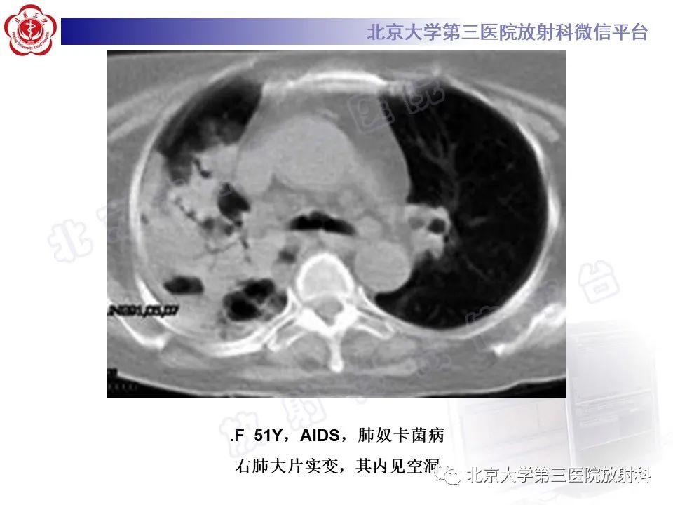 影像PPT - 【PPT】肺奴卡菌病-26