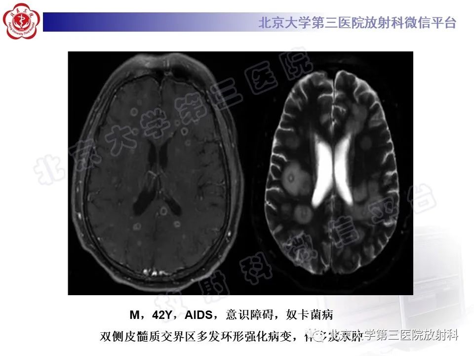 影像PPT - 【PPT】肺奴卡菌病-27