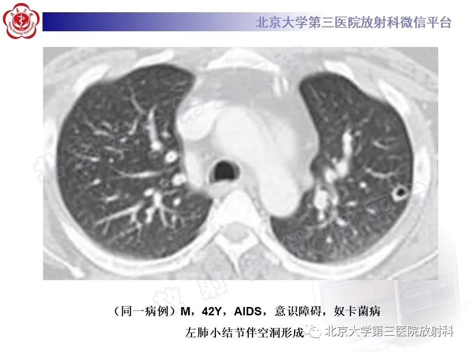 影像PPT - 【PPT】肺奴卡菌病-28