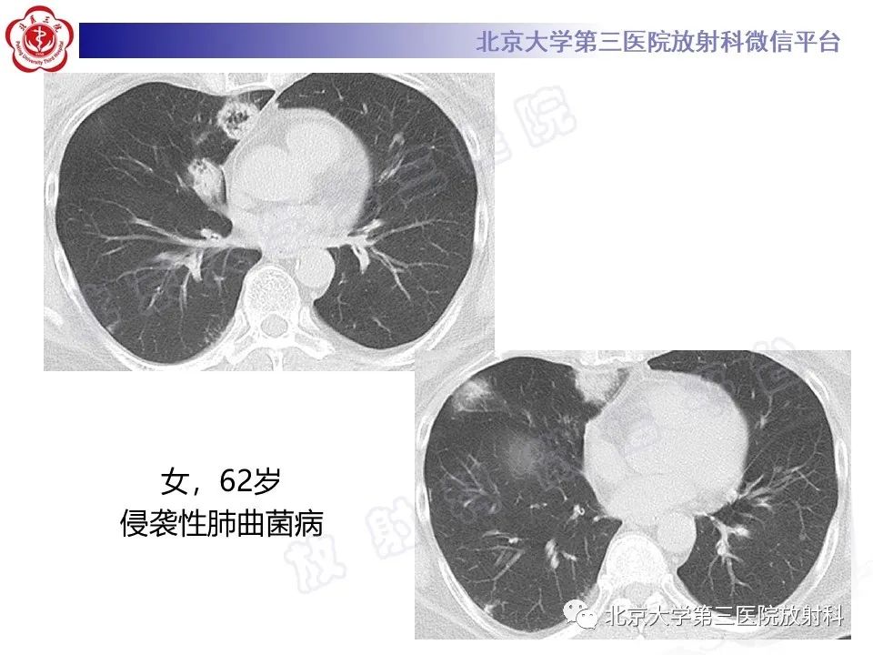 影像PPT - 【PPT】肺奴卡菌病-34