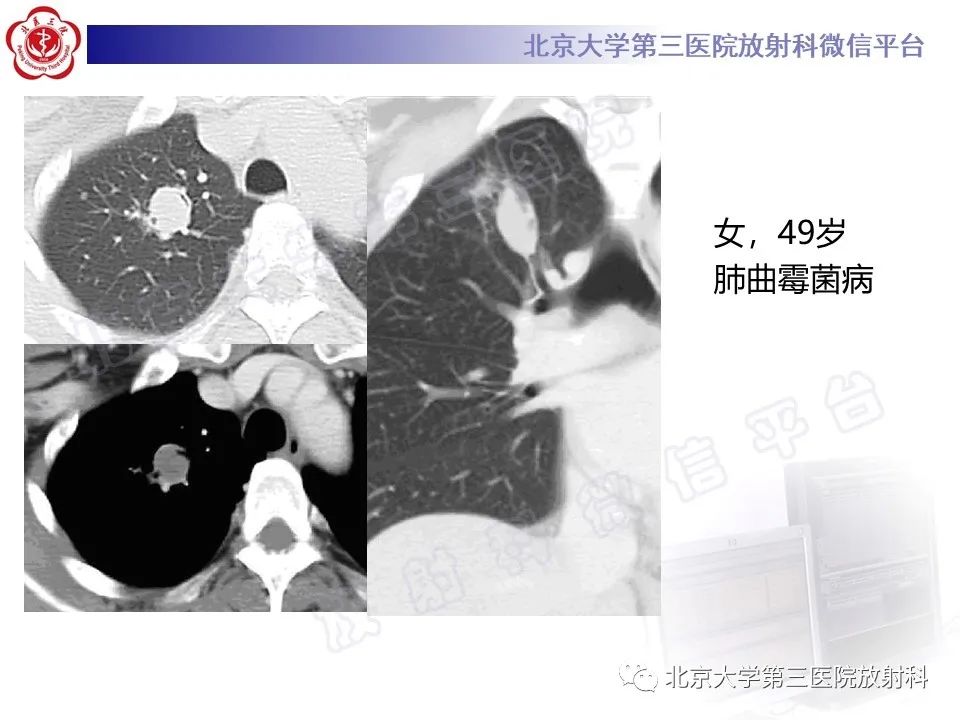 影像PPT - 【PPT】肺奴卡菌病-33