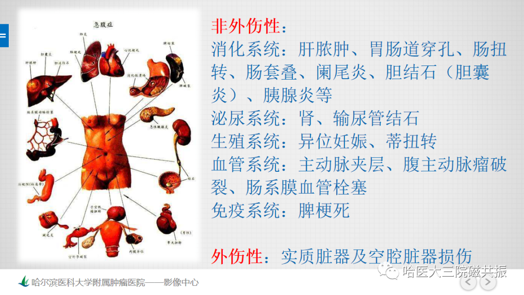 影像PPT - 【PPT】急腹症影像学诊断-3