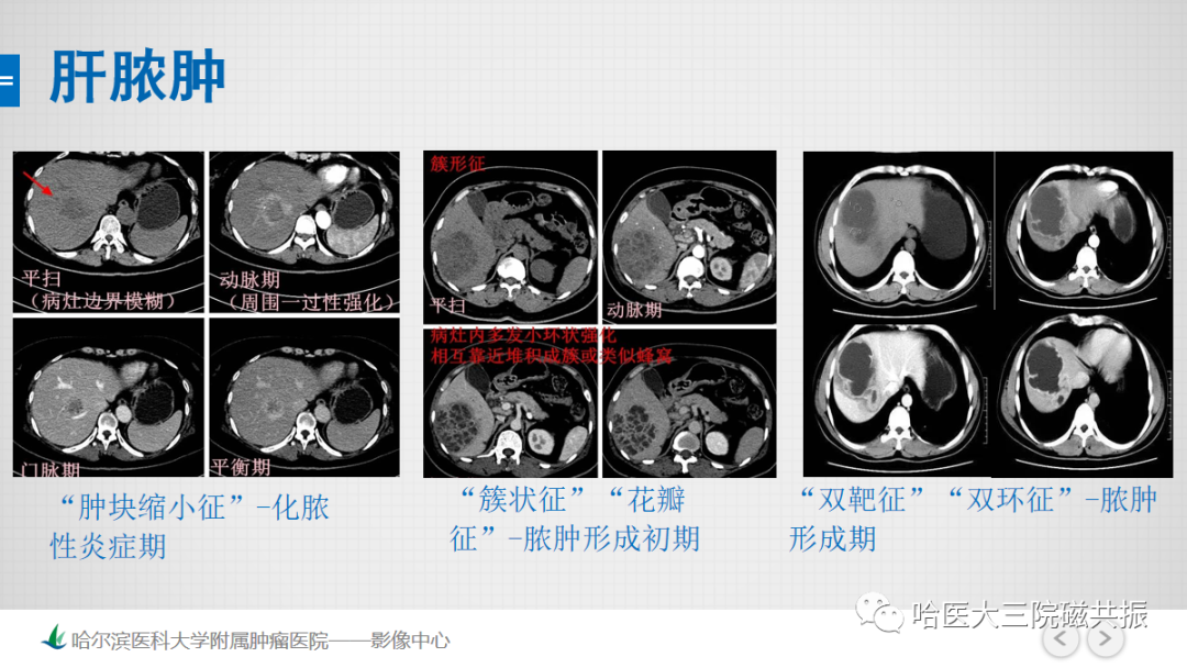 影像PPT - 【PPT】急腹症影像学诊断-5