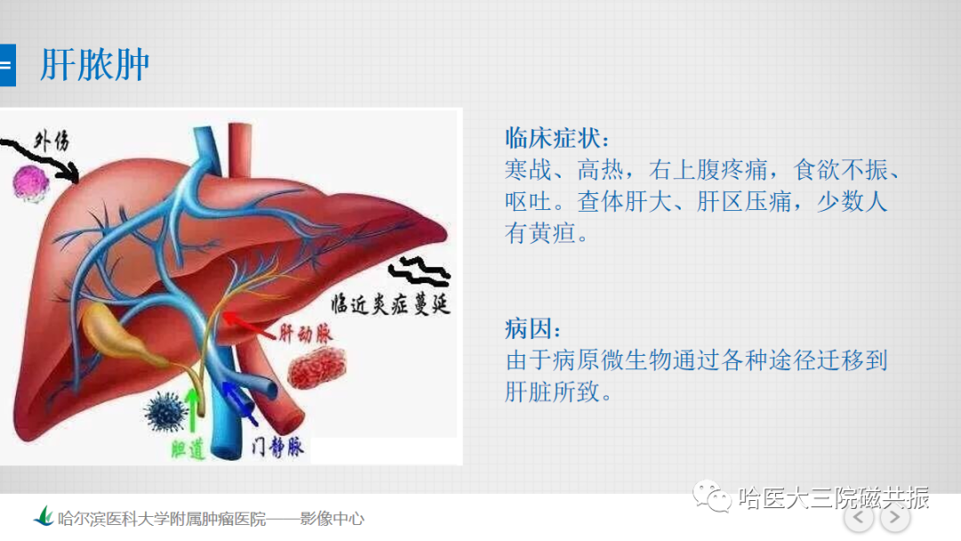 影像PPT - 【PPT】急腹症影像学诊断-4