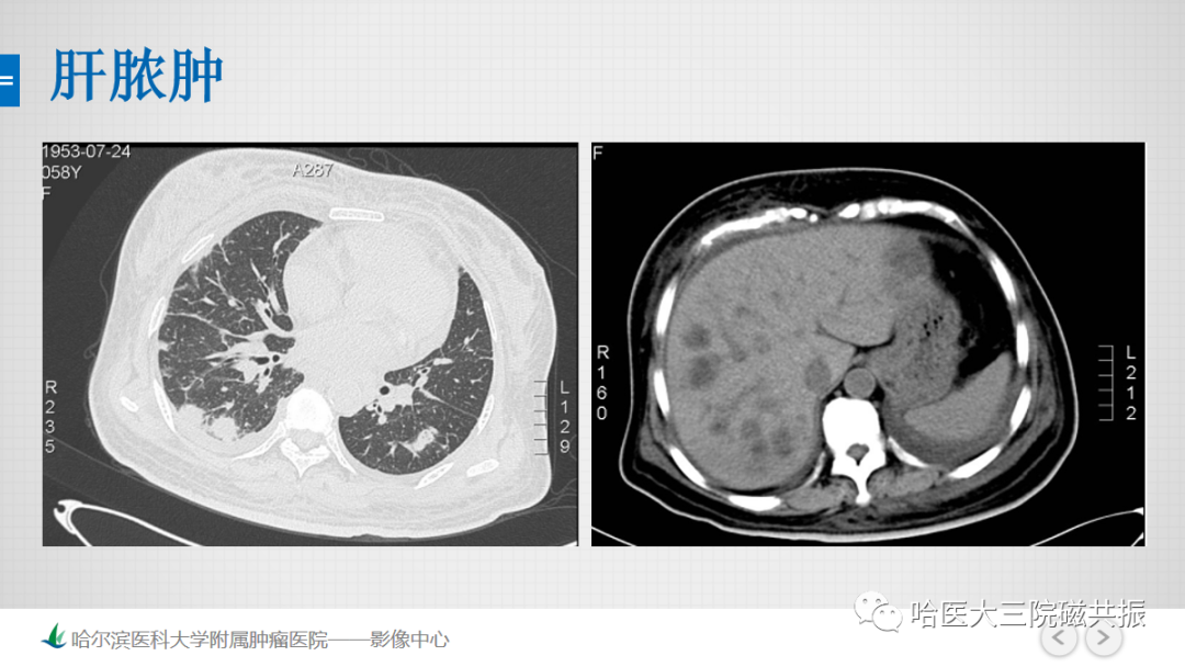 影像PPT - 【PPT】急腹症影像学诊断-6