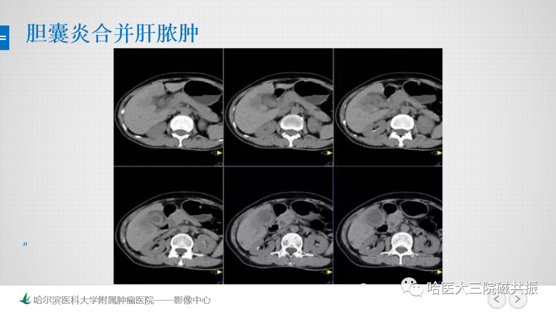 影像PPT - 【PPT】急腹症影像学诊断-7