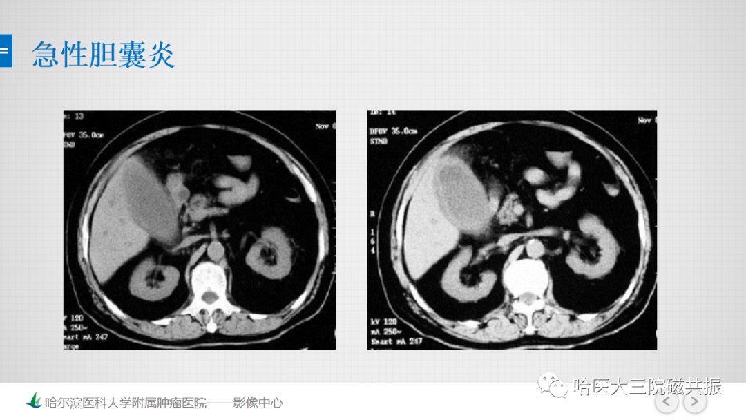 影像PPT - 【PPT】急腹症影像学诊断-9