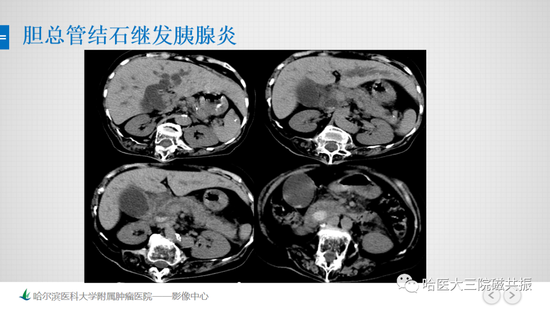 影像PPT - 【PPT】急腹症影像学诊断-12