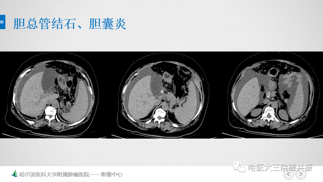 影像PPT - 【PPT】急腹症影像学诊断-11