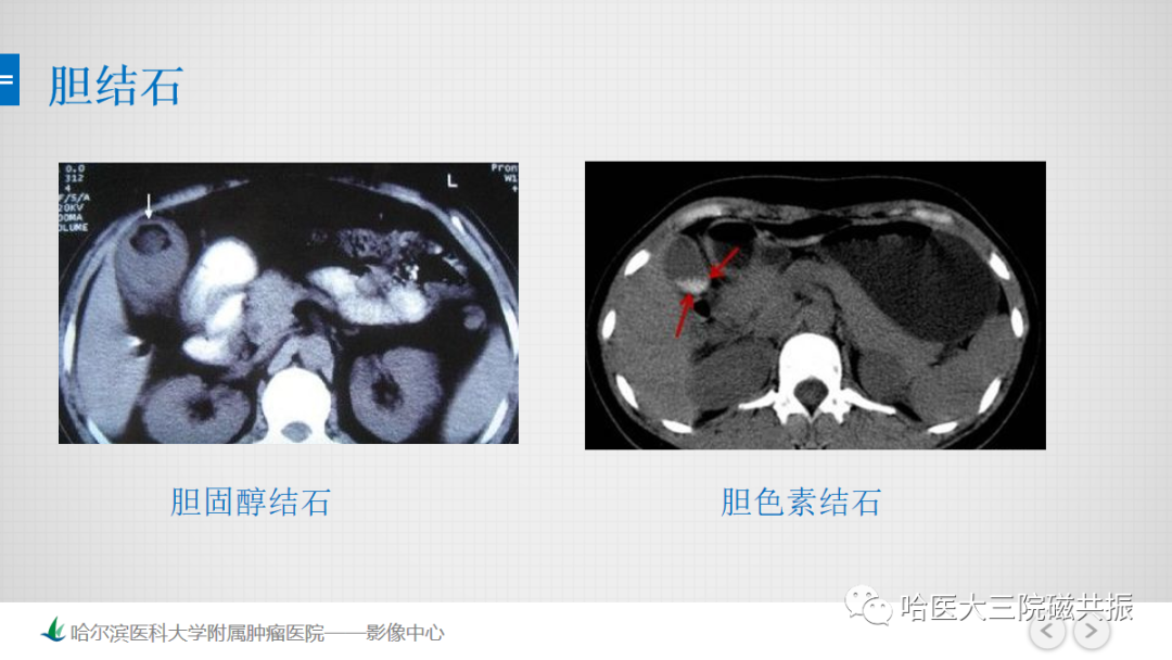 影像PPT - 【PPT】急腹症影像学诊断-10