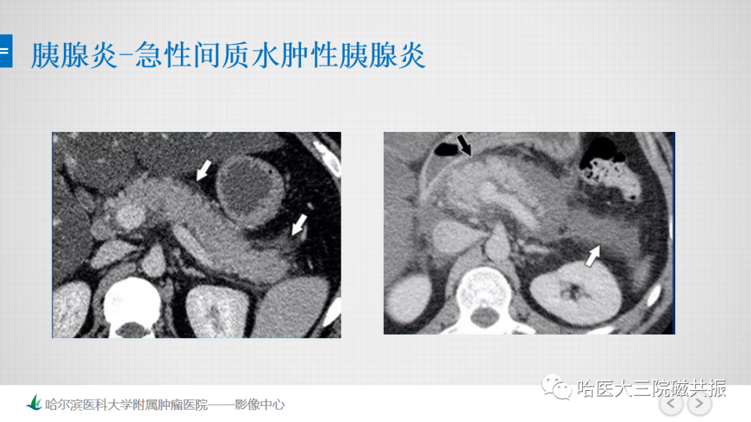 影像PPT - 【PPT】急腹症影像学诊断-15