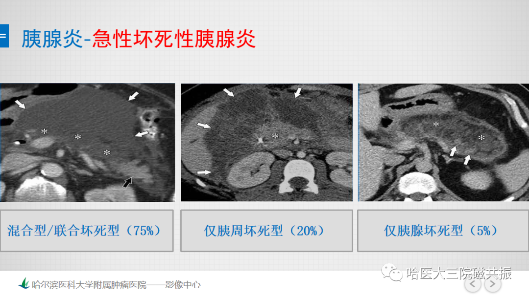 影像PPT - 【PPT】急腹症影像学诊断-16