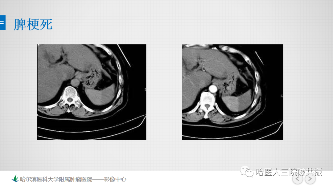 影像PPT - 【PPT】急腹症影像学诊断-18
