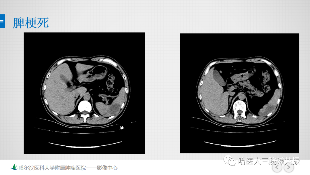 影像PPT - 【PPT】急腹症影像学诊断-19