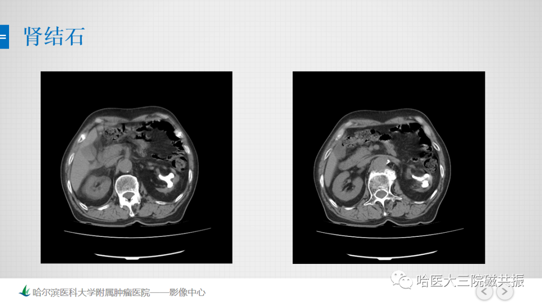 影像PPT - 【PPT】急腹症影像学诊断-21