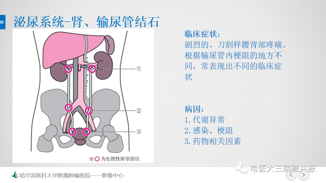 影像PPT - 【PPT】急腹症影像学诊断-20