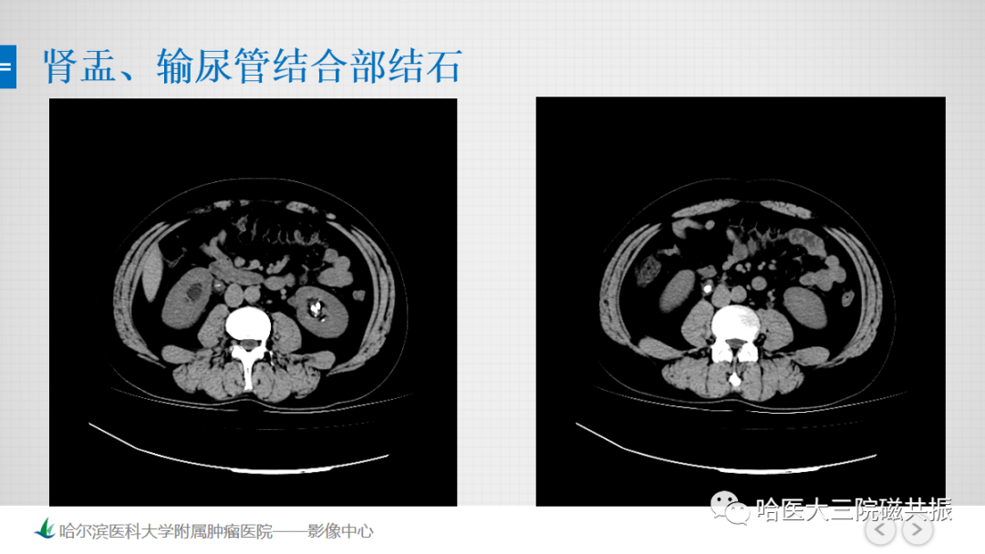 影像PPT - 【PPT】急腹症影像学诊断-22
