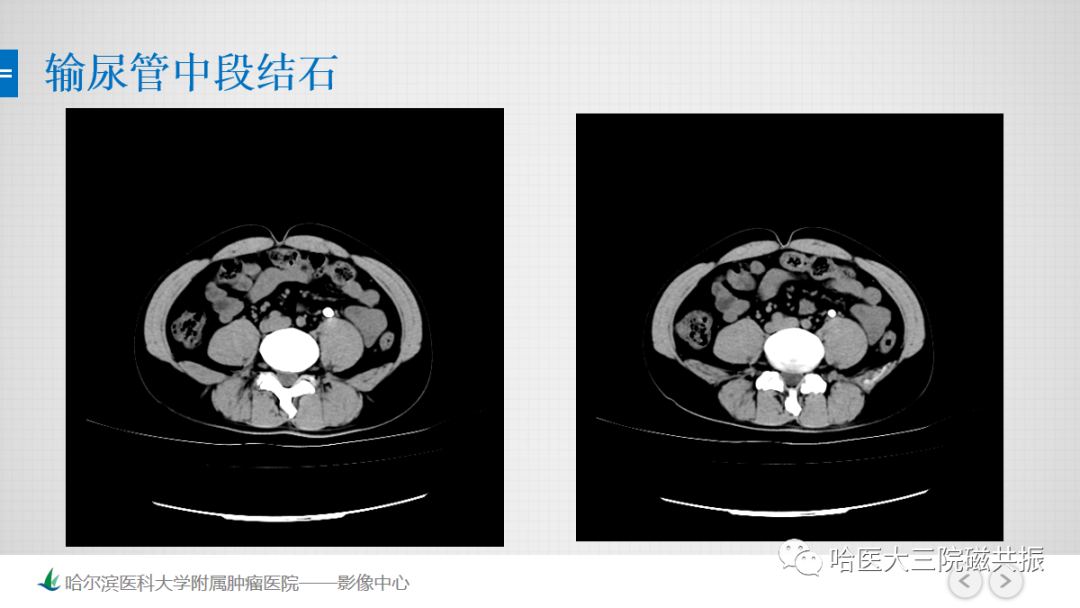 影像PPT - 【PPT】急腹症影像学诊断-23