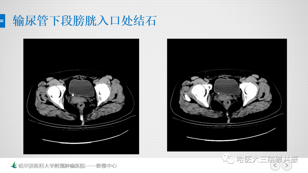 影像PPT - 【PPT】急腹症影像学诊断-24