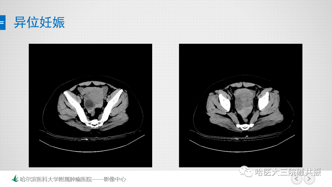 影像PPT - 【PPT】急腹症影像学诊断-26