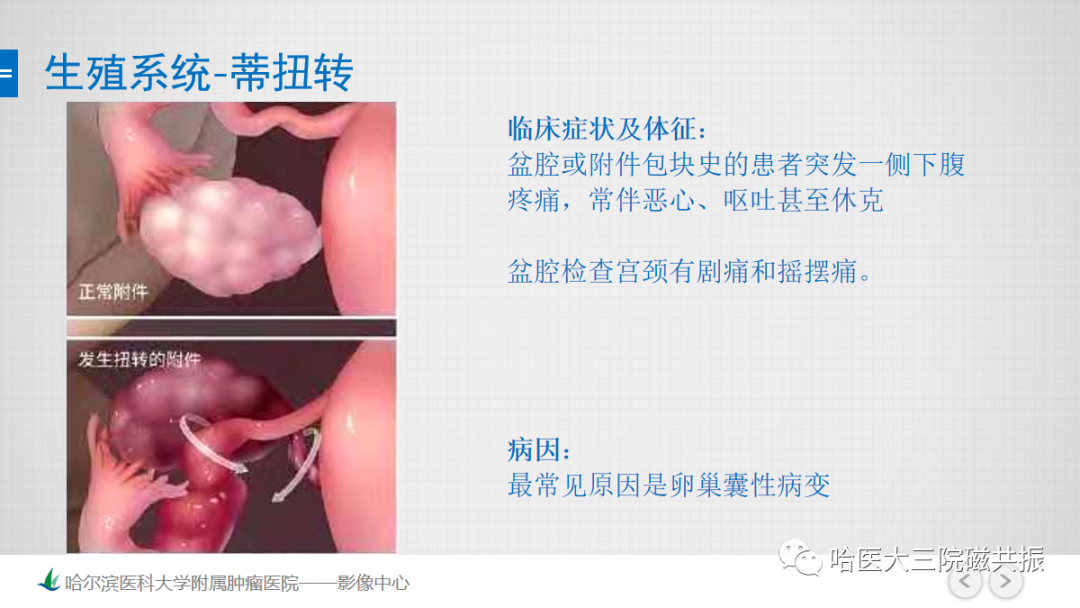 影像PPT - 【PPT】急腹症影像学诊断-27