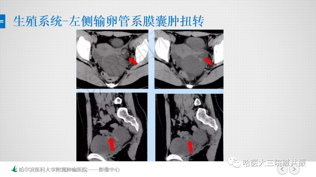影像PPT - 【PPT】急腹症影像学诊断-28