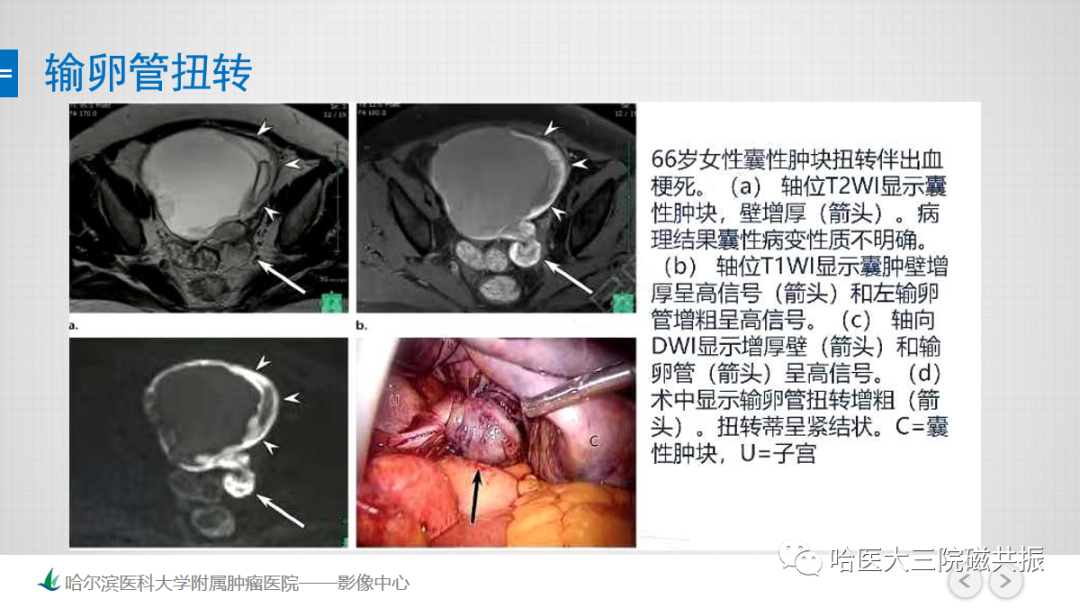 影像PPT - 【PPT】急腹症影像学诊断-29