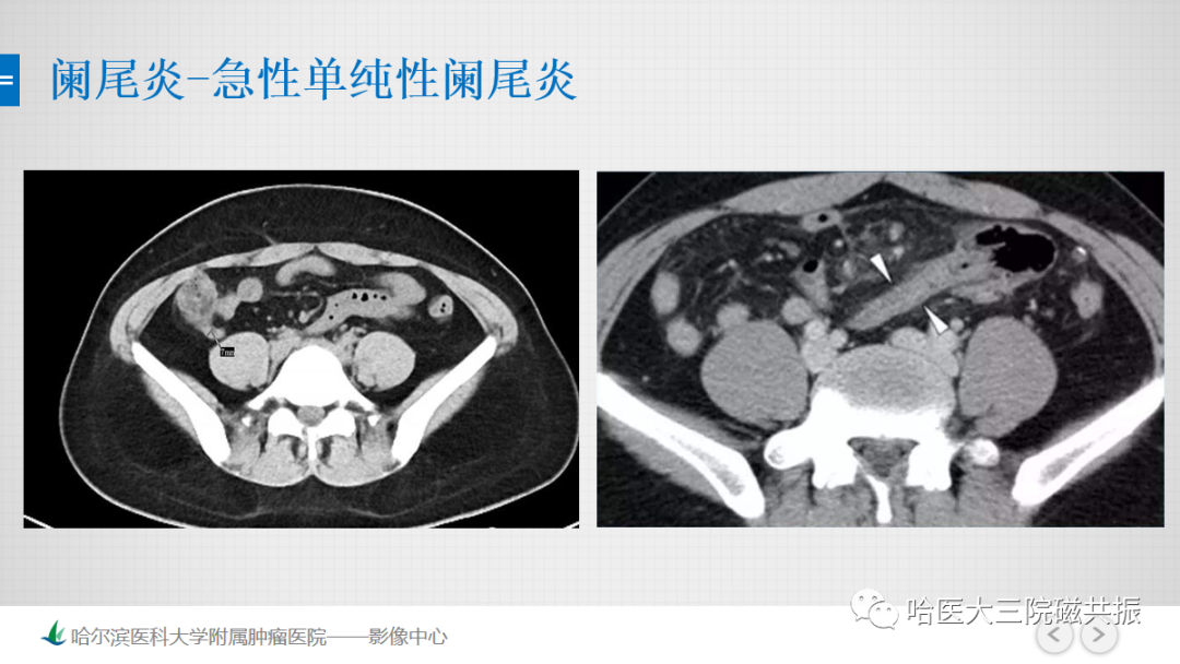 影像PPT - 【PPT】急腹症影像学诊断-32