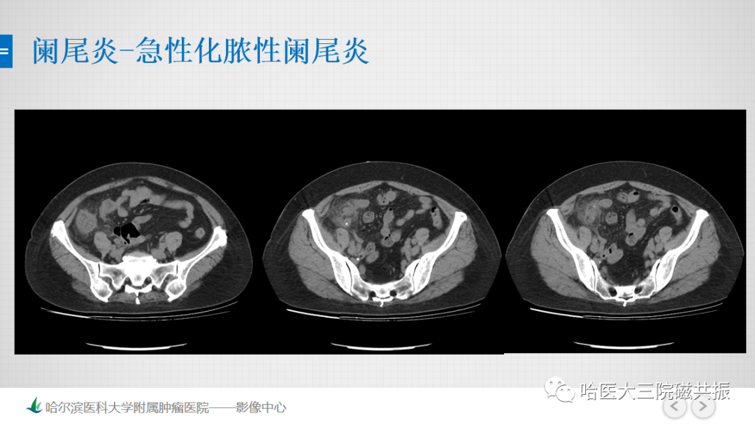 影像PPT - 【PPT】急腹症影像学诊断-33