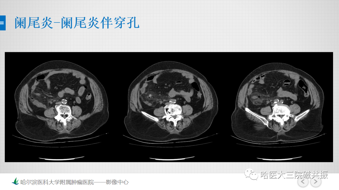 影像PPT - 【PPT】急腹症影像学诊断-34