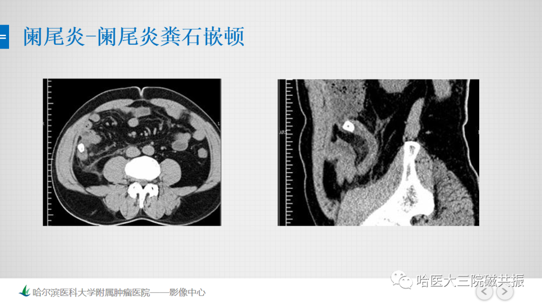 影像PPT - 【PPT】急腹症影像学诊断-35
