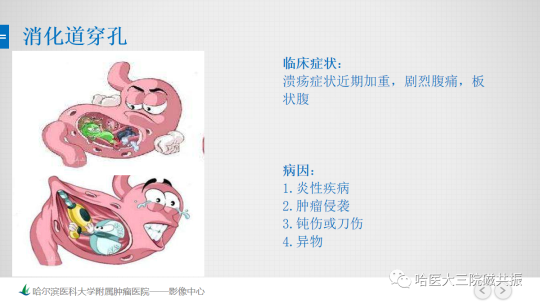 影像PPT - 【PPT】急腹症影像学诊断-36