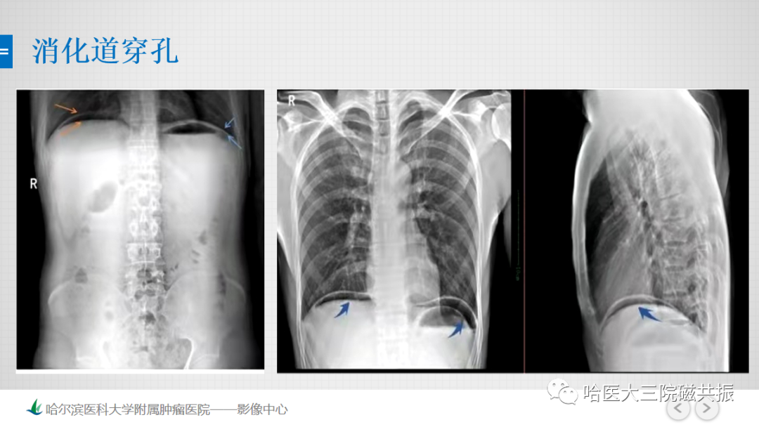 影像PPT - 【PPT】急腹症影像学诊断-37
