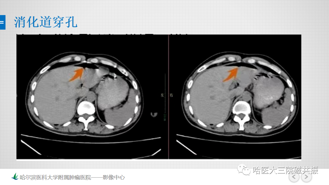 影像PPT - 【PPT】急腹症影像学诊断-38