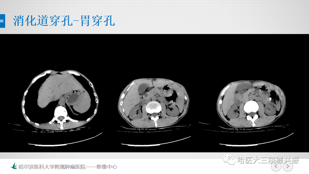 影像PPT - 【PPT】急腹症影像学诊断-39