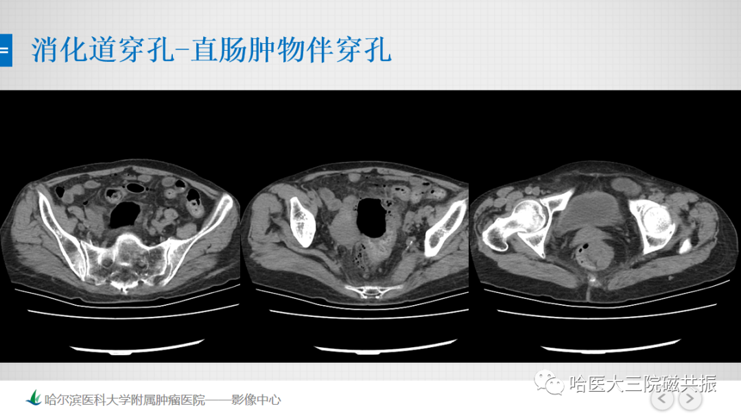 影像PPT - 【PPT】急腹症影像学诊断-40