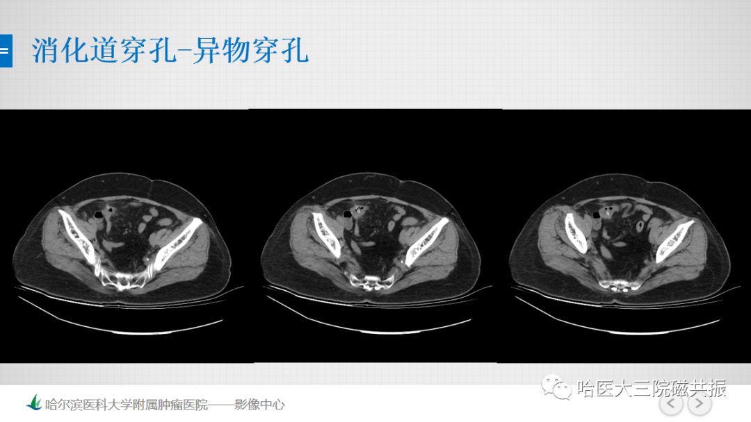 影像PPT - 【PPT】急腹症影像学诊断-41