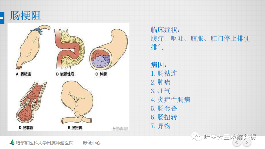 影像PPT - 【PPT】急腹症影像学诊断-42