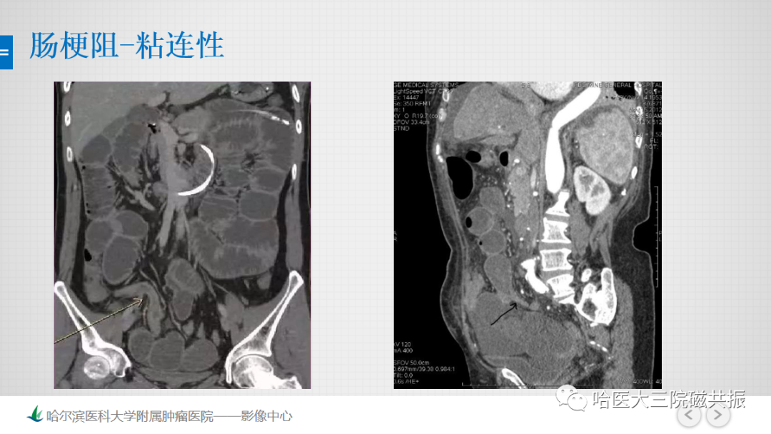 影像PPT - 【PPT】急腹症影像学诊断-43