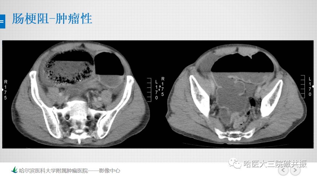 影像PPT - 【PPT】急腹症影像学诊断-44