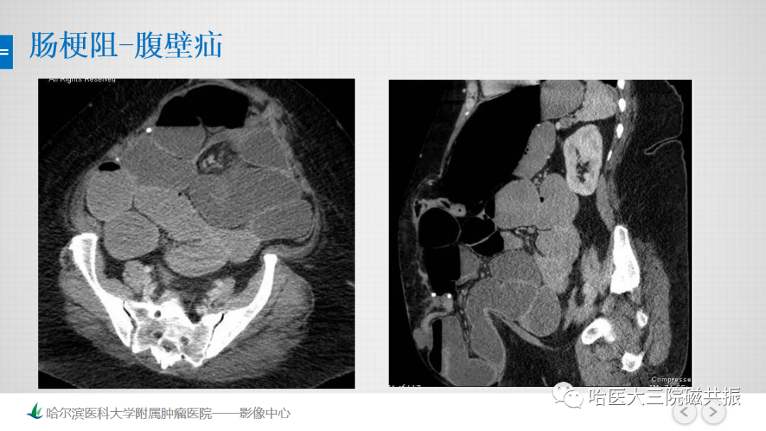 影像PPT - 【PPT】急腹症影像学诊断-45