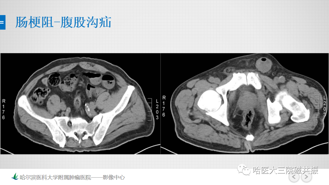 影像PPT - 【PPT】急腹症影像学诊断-46