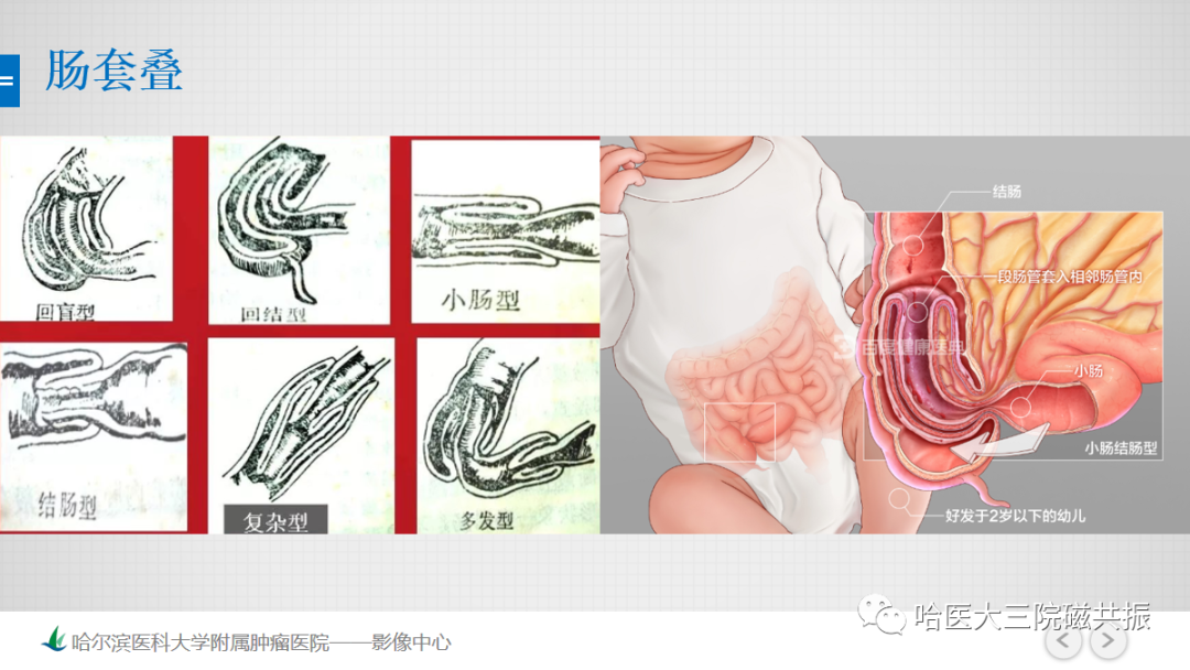 影像PPT - 【PPT】急腹症影像学诊断-47