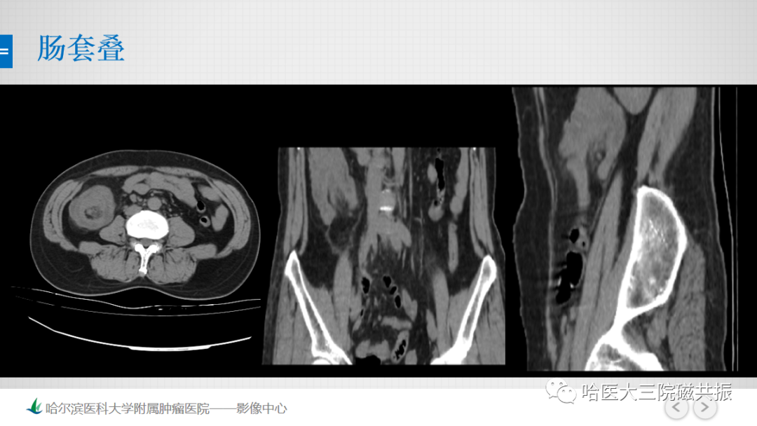 影像PPT - 【PPT】急腹症影像学诊断-48