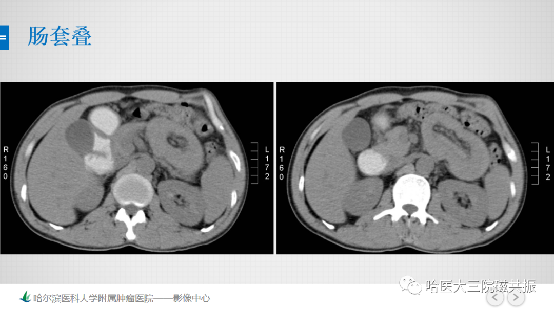 影像PPT - 【PPT】急腹症影像学诊断-49